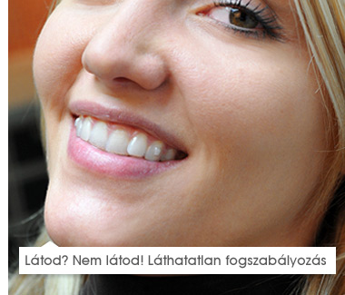 invisalign